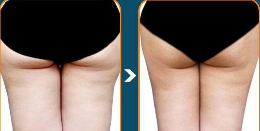 Bạn Đã Biết Sử Dụng Kem Tan Mỡ Dúng Cách Bạn Đã Biết Sử Dụng Kem Tan Mỡ Dúng Cách